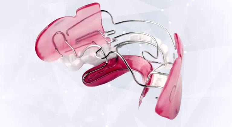 Исправление прикуса: сколько времени длится лечение и почему нельзя быстрее